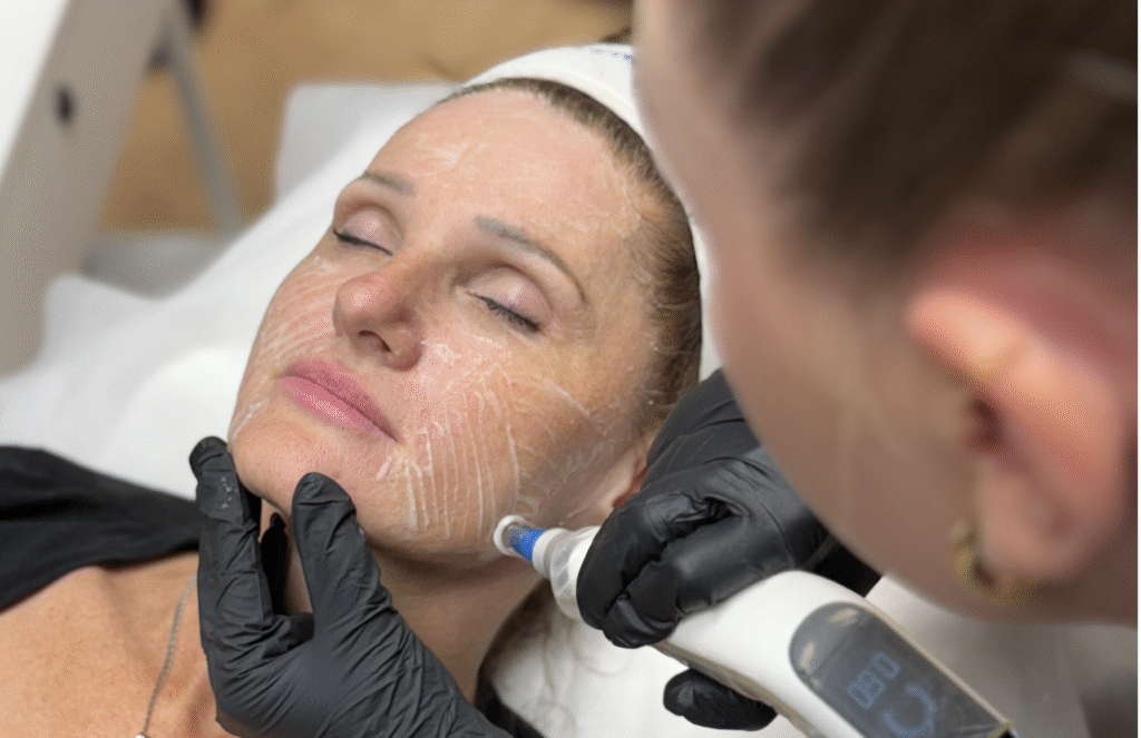 En dame får dermapen 4 behandling i ansiktet